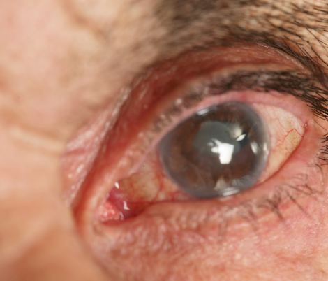 glaucoma