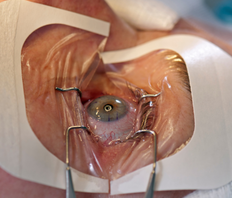 glaucoma
