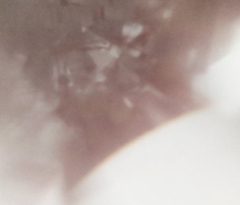 glaucoma