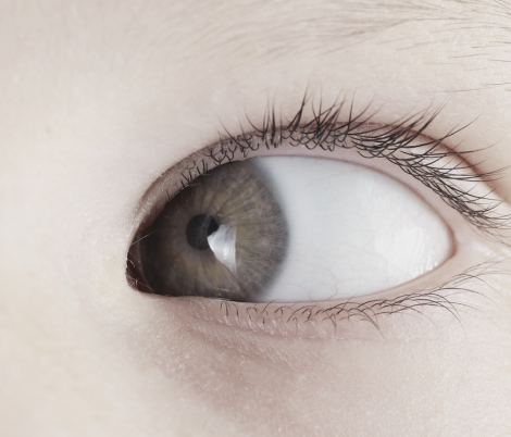 cataracts